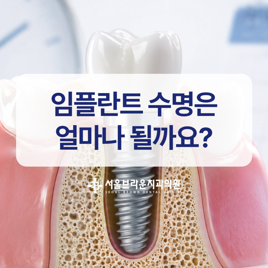 대전임플란트, 임플란트 수명은 얼마나 될까요?