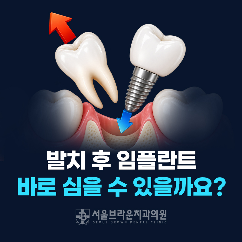 대전 당일 임플란트, 발치 후 바로 식립할 수 있을까요?