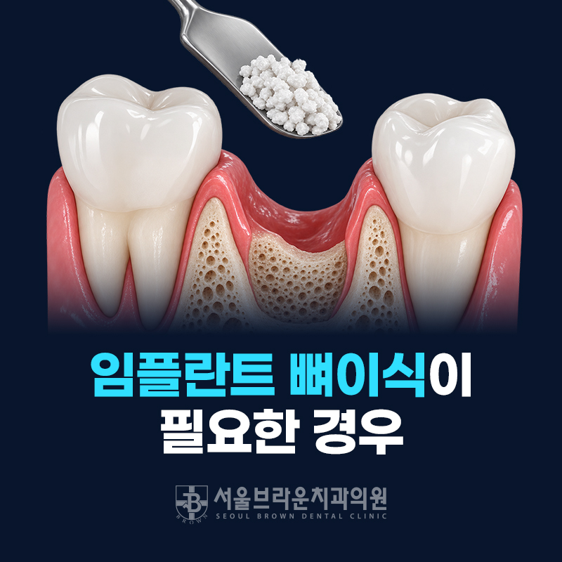 대전임플란트 뼈이식, 꼭 필요한 경우는 언제일까요?