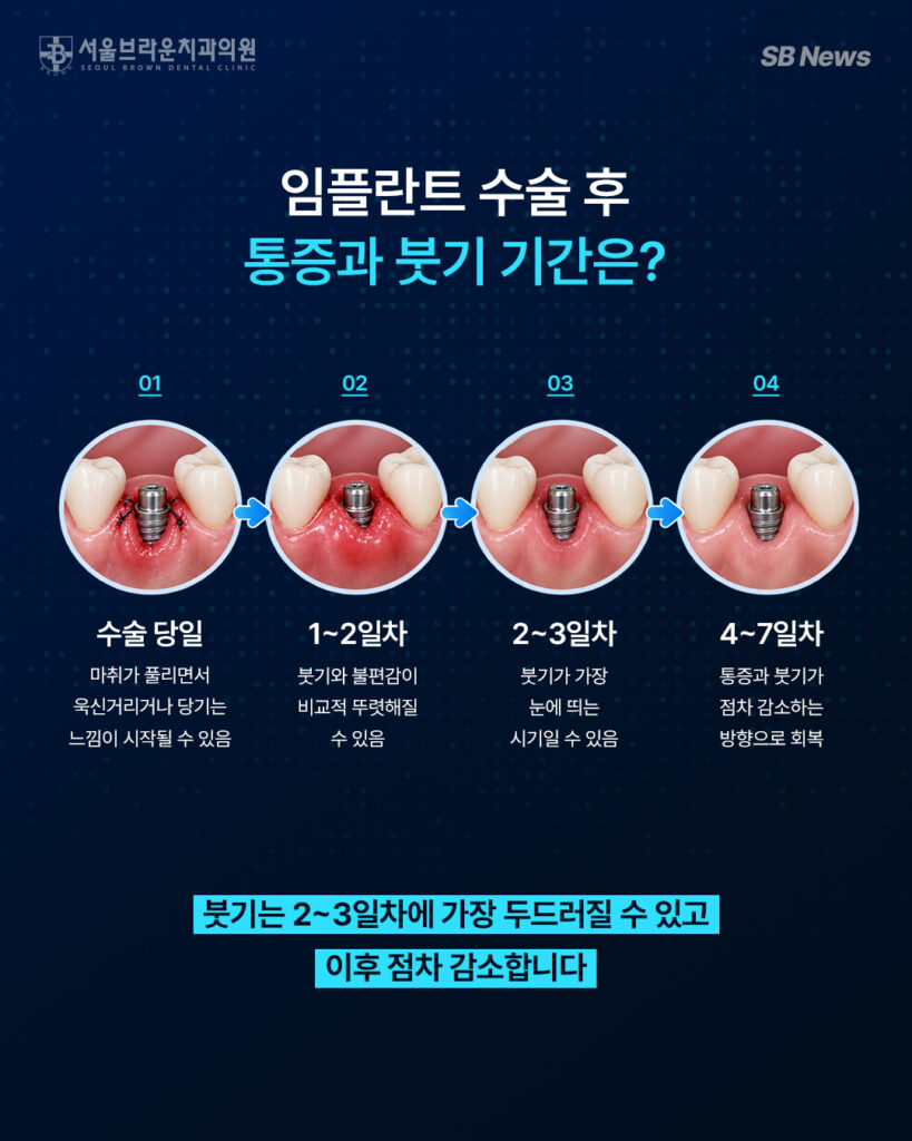 임플란트 수술 후 통증과 붓기가 나타나고 점차 회복되는 과정을 설명하는 이미지