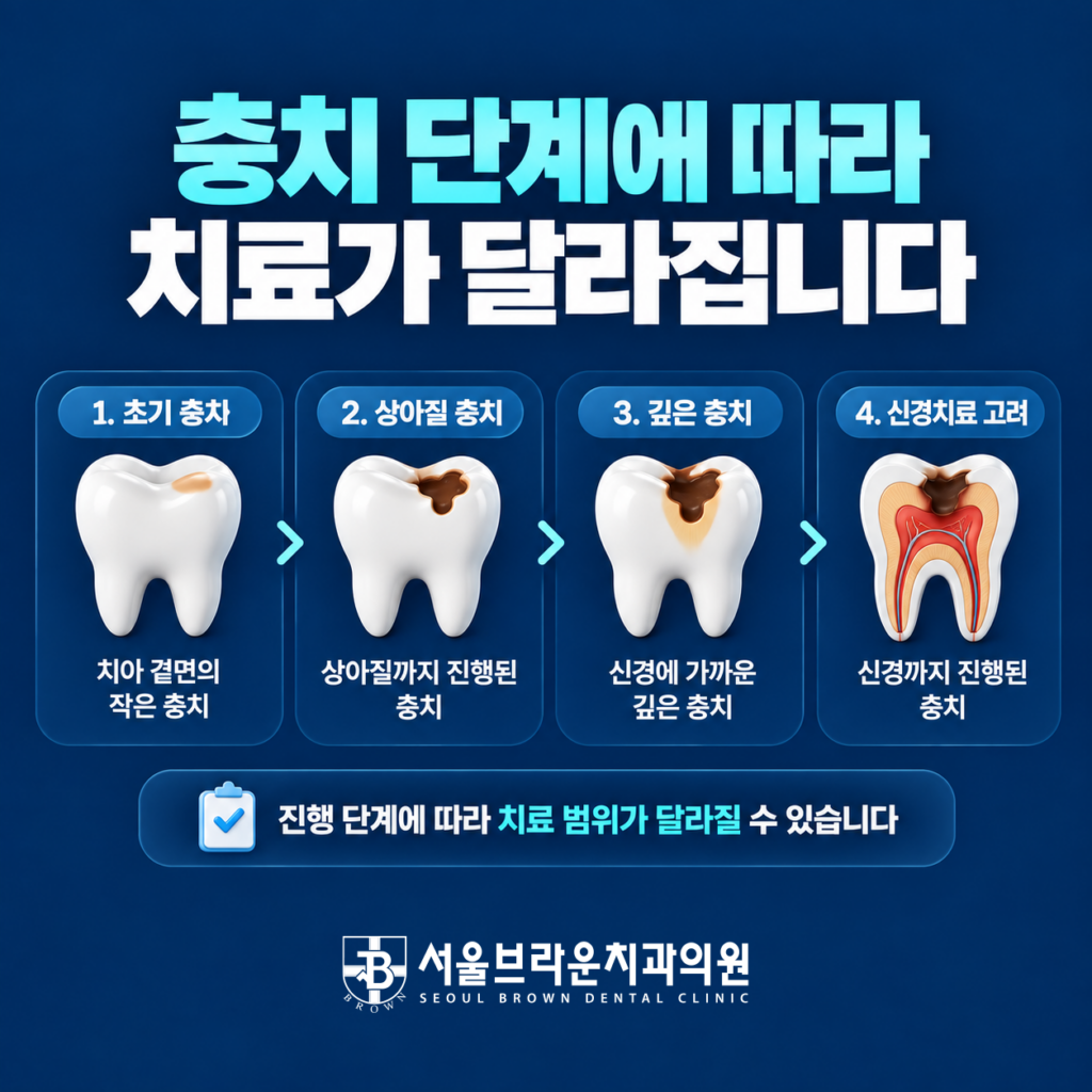 법랑질 초기 충치 상아질 충치 깊은 충치와 신경까지 진행된 충치 치료 단계를 설명한 이미지