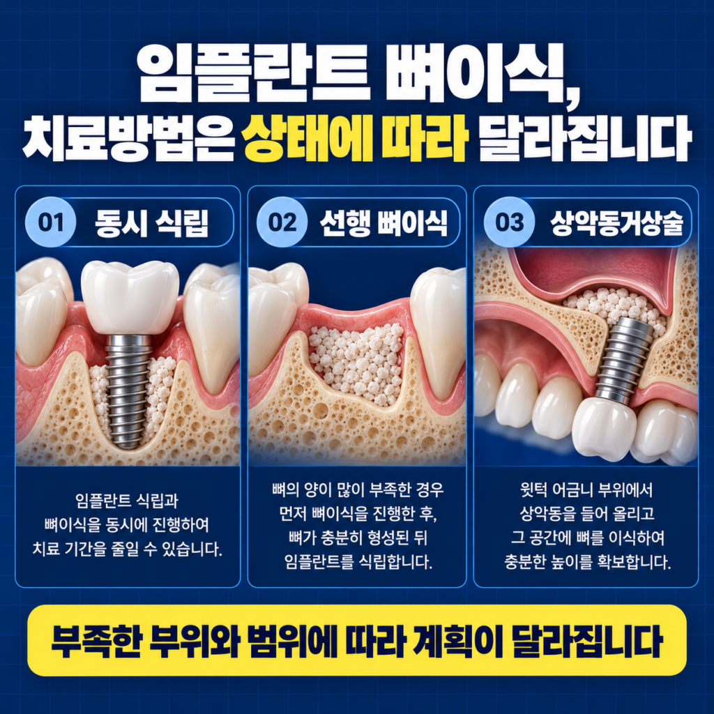 임플란트 뼈이식에서 동시 식립 선행 뼈이식 상악동거상술 등 치료방법 차이를 설명하는 이미지