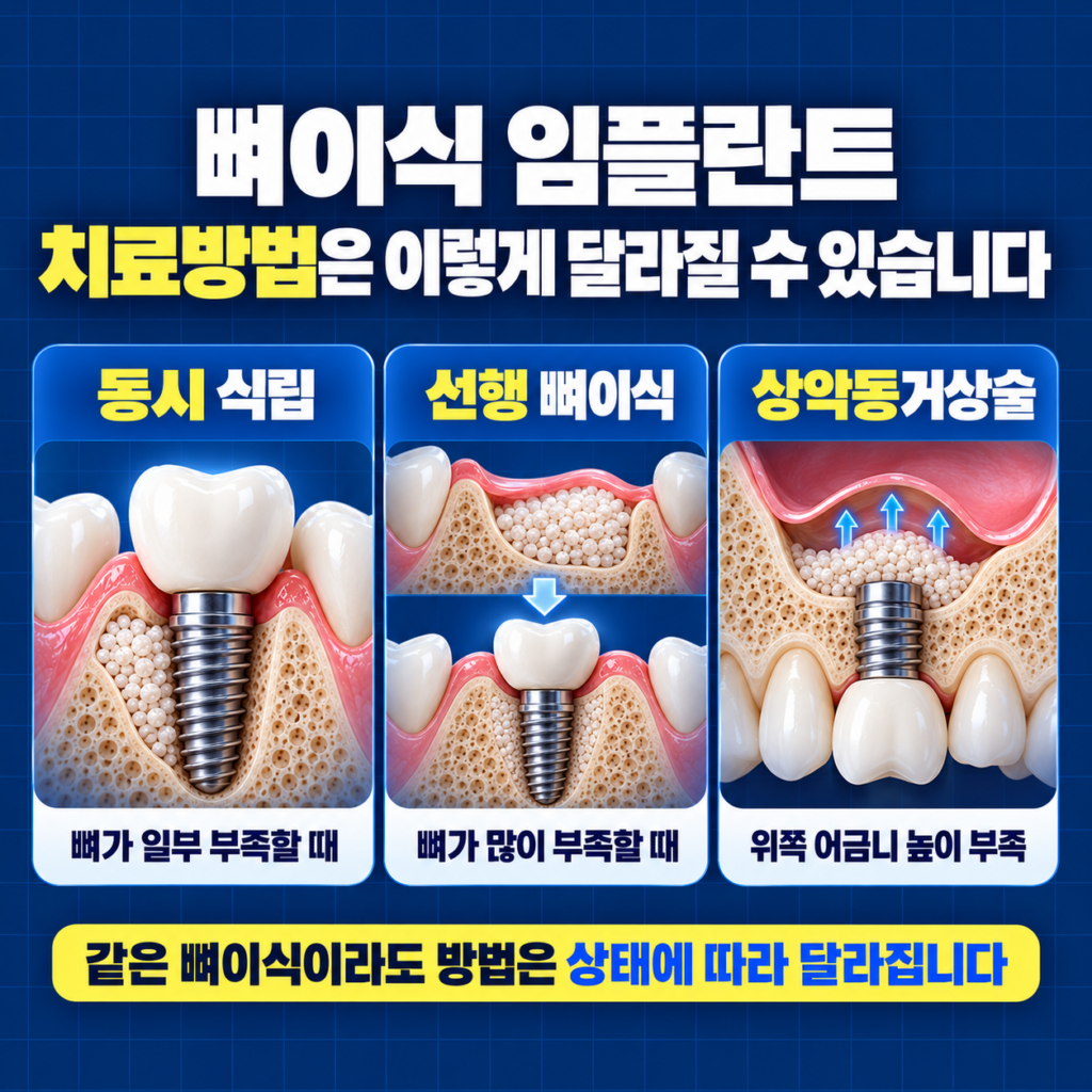 임플란트 뼈이식의 동시 식립 선행 골이식 상악동거상술 치료방법을 비교한 이미지