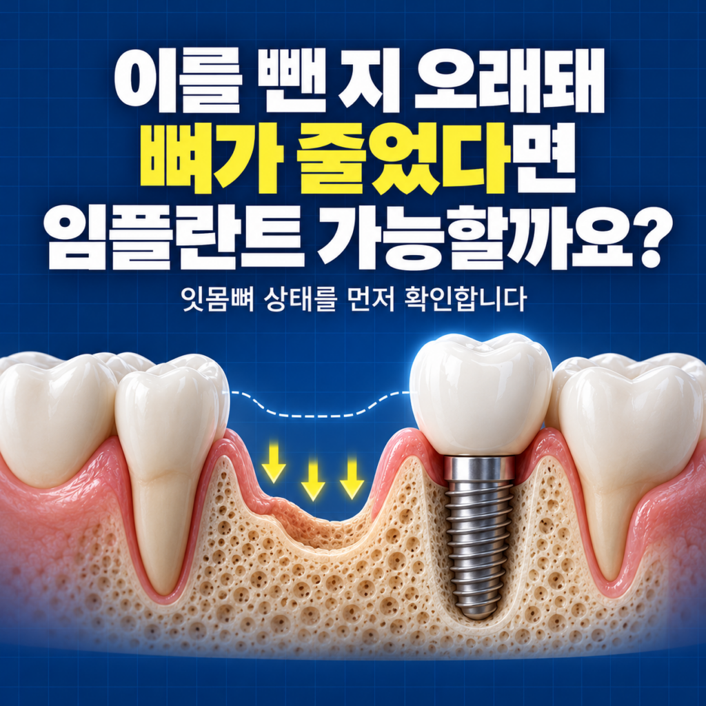 이를 뺀 지 오래돼서 뼈가 줄었다는데, 대전에서 임플란트 가능할까요?