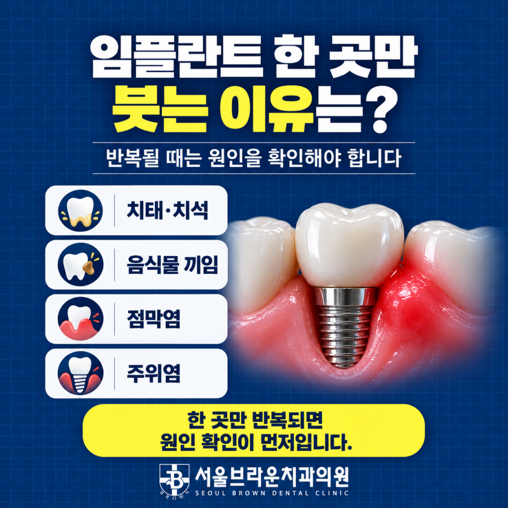 임플란트 주변 치태 음식물 끼임 점막염 주위염 등 한 곳 잇몸이 붓는 원인을 설명한 이미지