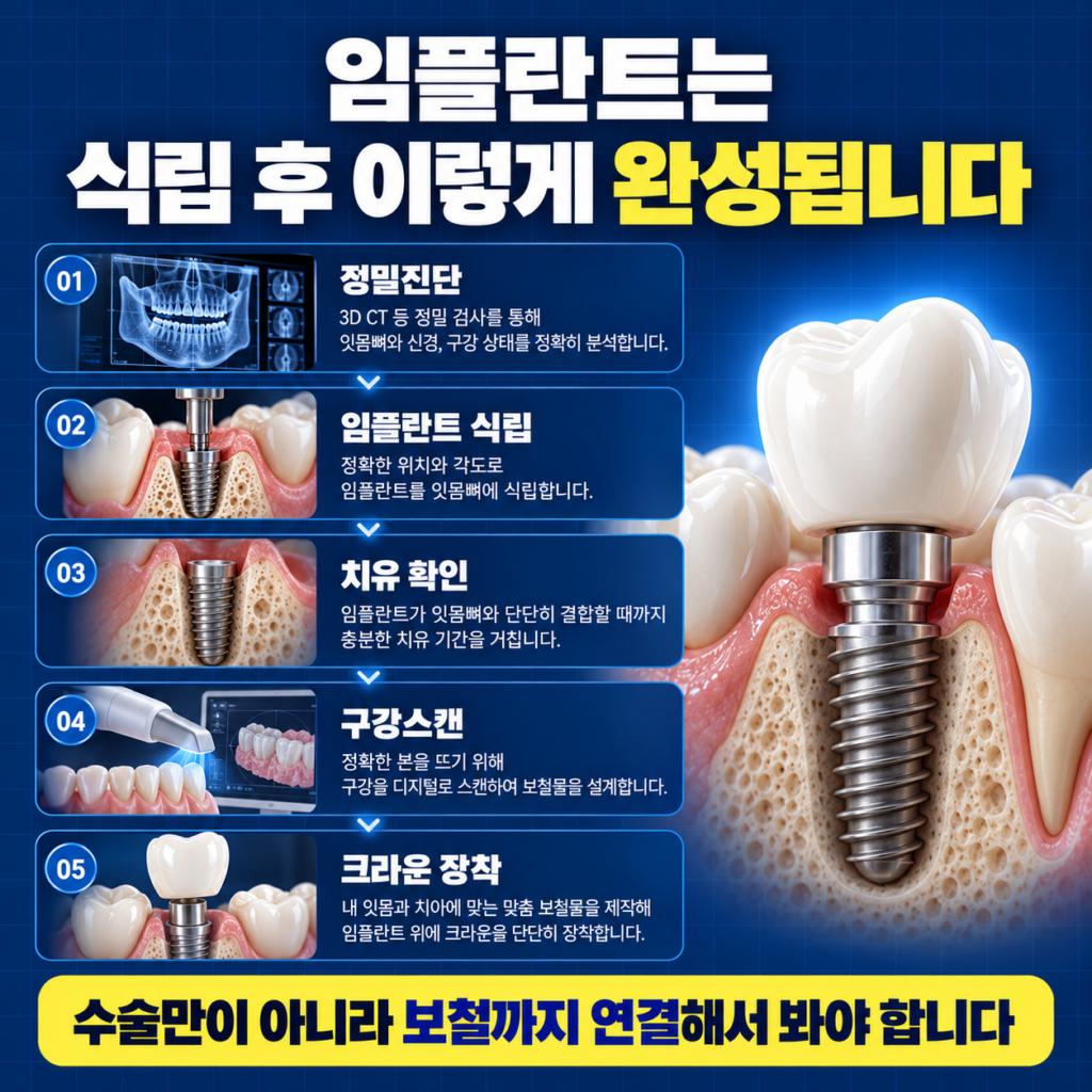 임플란트 식립 후 치유 지대주 연결 구강스캔 크라운 제작과 교합 조정 과정을 설명하는 이미지