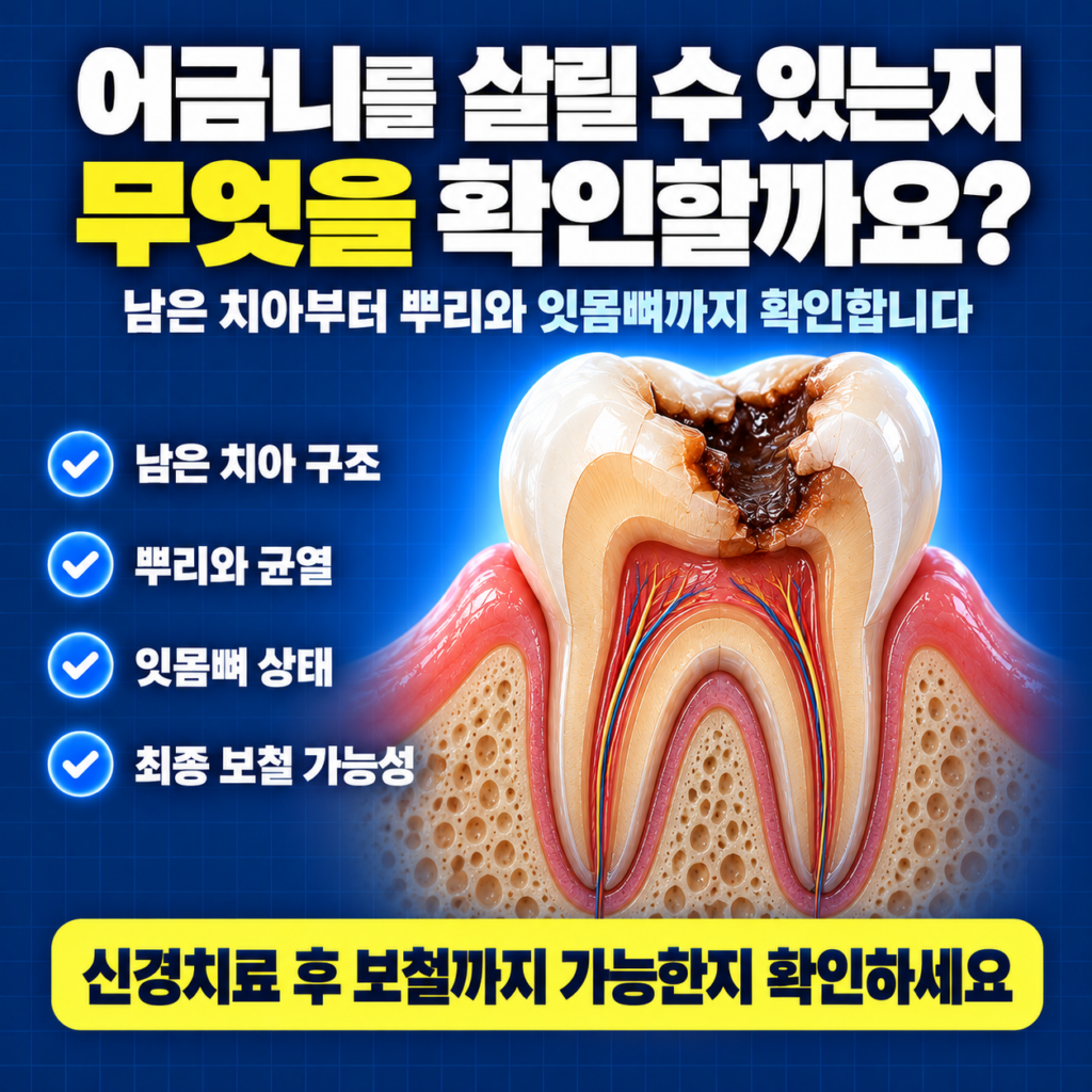심하게 썩은 어금니의 남은 치아 뿌리 균열 잇몸뼈와 최종 크라운 가능성을 확인하는 이미지