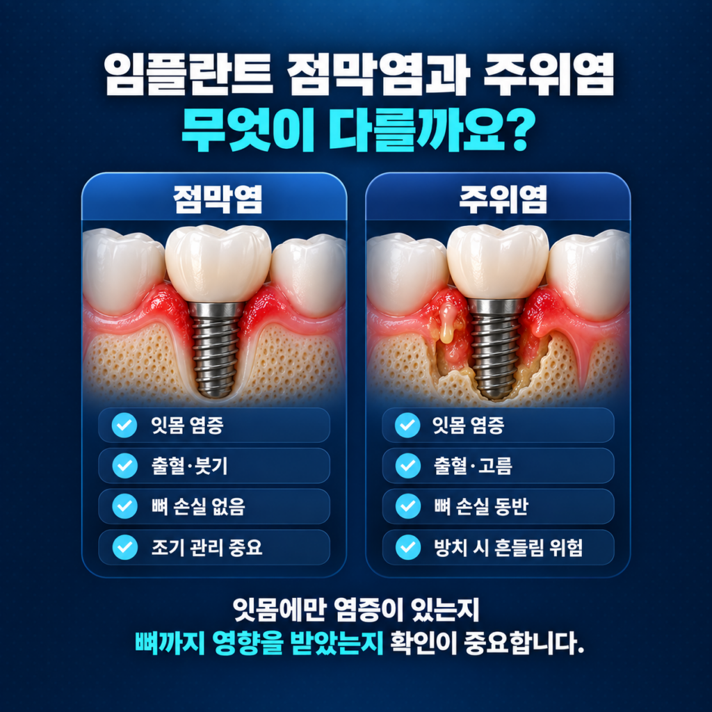 임플란트 주변 잇몸에만 염증이 있는 점막염과 뼈 손실이 동반되는 임플란트 주위염 차이를 비교한 이미지
