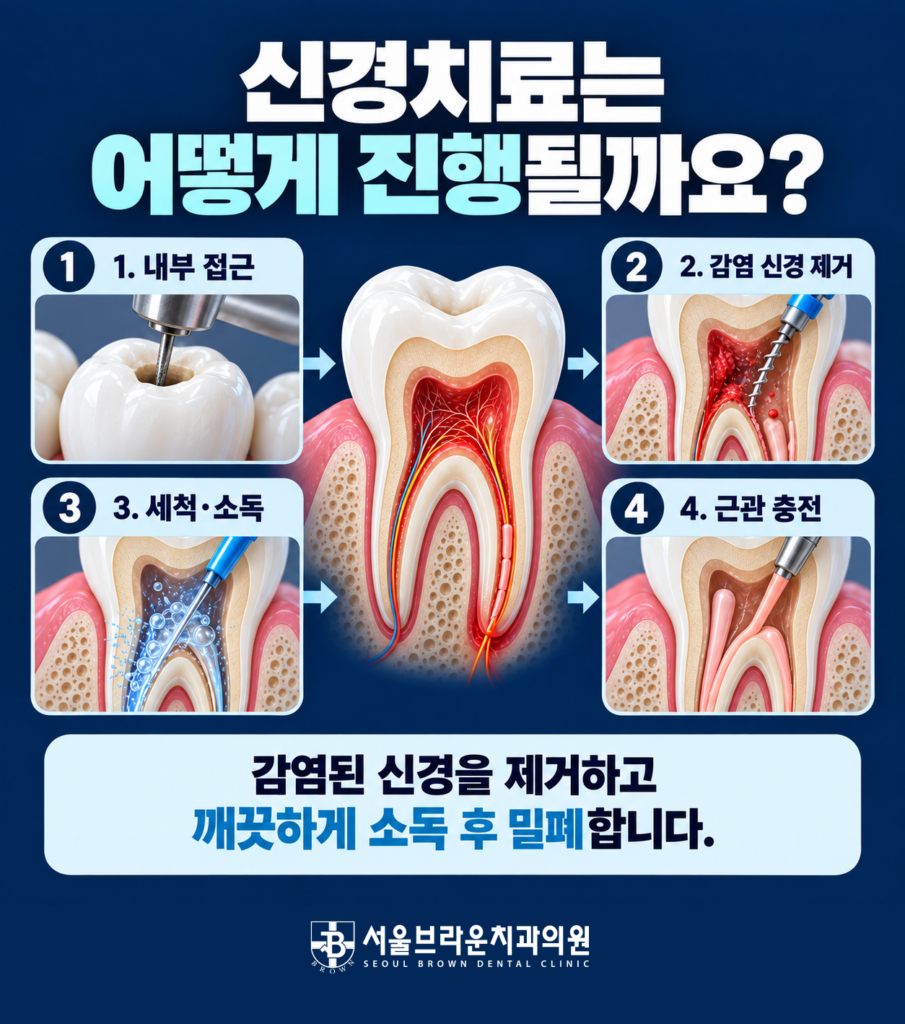 신경치료에서 감염된 신경 제거 세척 소독 근관 충전까지의 치료 과정을 설명하는 이미지