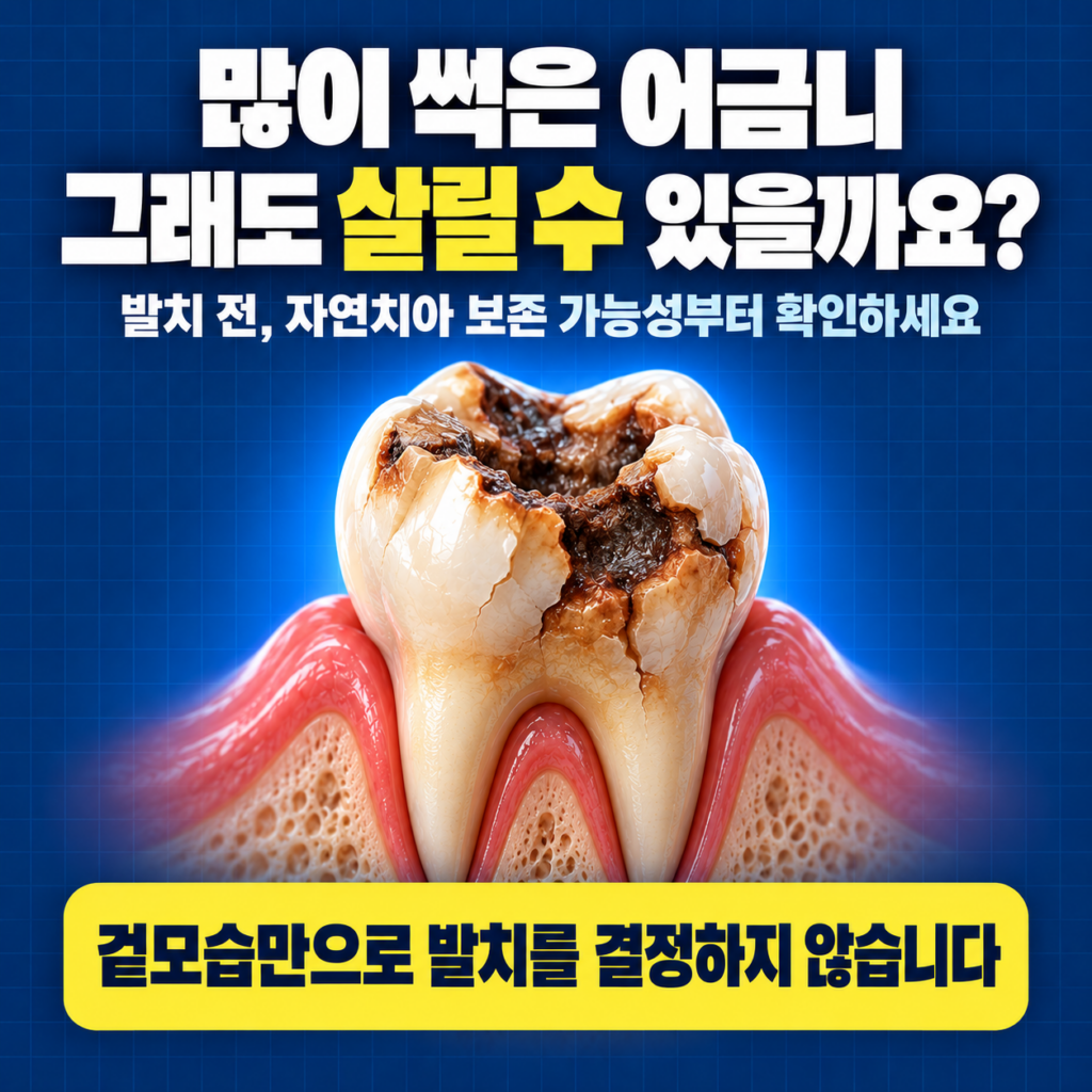 대전 어금니 충치 고민, 어금니가 많이 썩었는데 살릴 수 있는지부터 봐주는 대전 치과 추천해줘